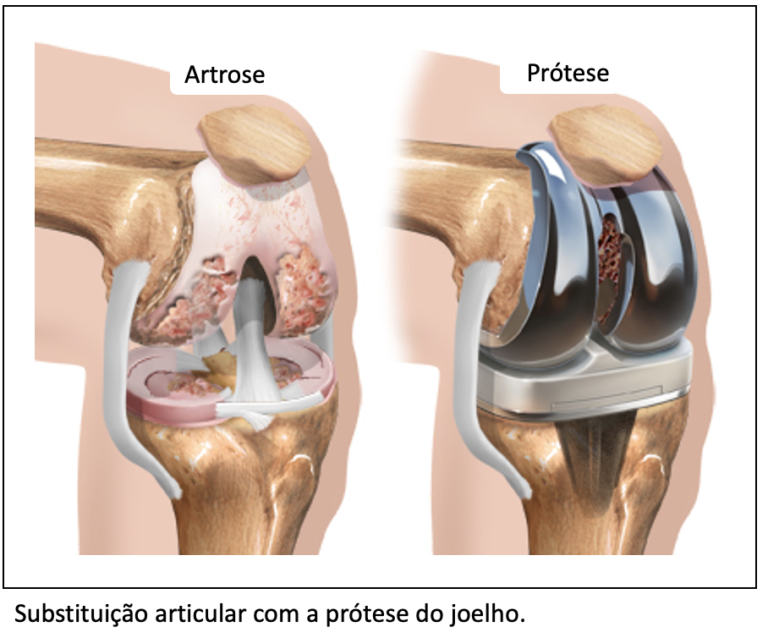 Cirurgia do joelho